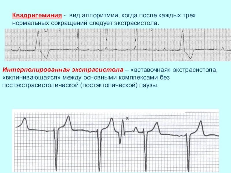 Экстрасистолы на ЭКГ бигеминия. Вставочные предсердные экстрасистолы на ЭКГ. Интерполированная желудочковая экстрасистолия на ЭКГ. Вставочные желудочковые экстрасистолы на ЭКГ. 10 экстрасистола