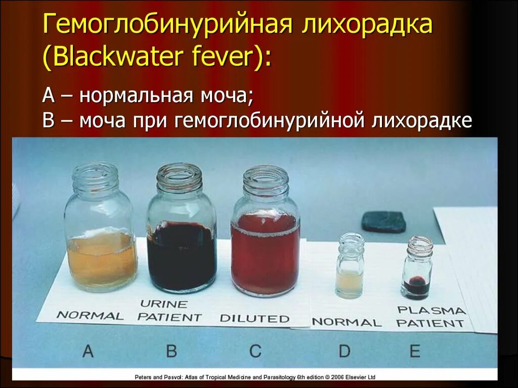 Гемоглобинурийная лихорадка при тропической малярии. Гемоглобинурийная лихорадка. Гемоглобинурийная лихорадка при малярии. Моча при гемоглобинурийной лихорадке при малярии. Осложнения гемоглобинурийной лихорадки.