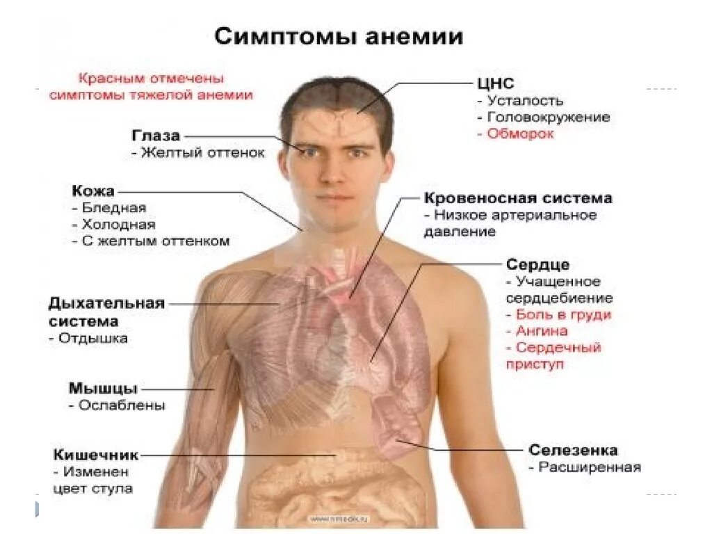 Состояние при анемии. Анемия симптомы у подростков. малокровие симптомы у подростка. тяжелая анемия симптомы. приступ анемии симптомы.