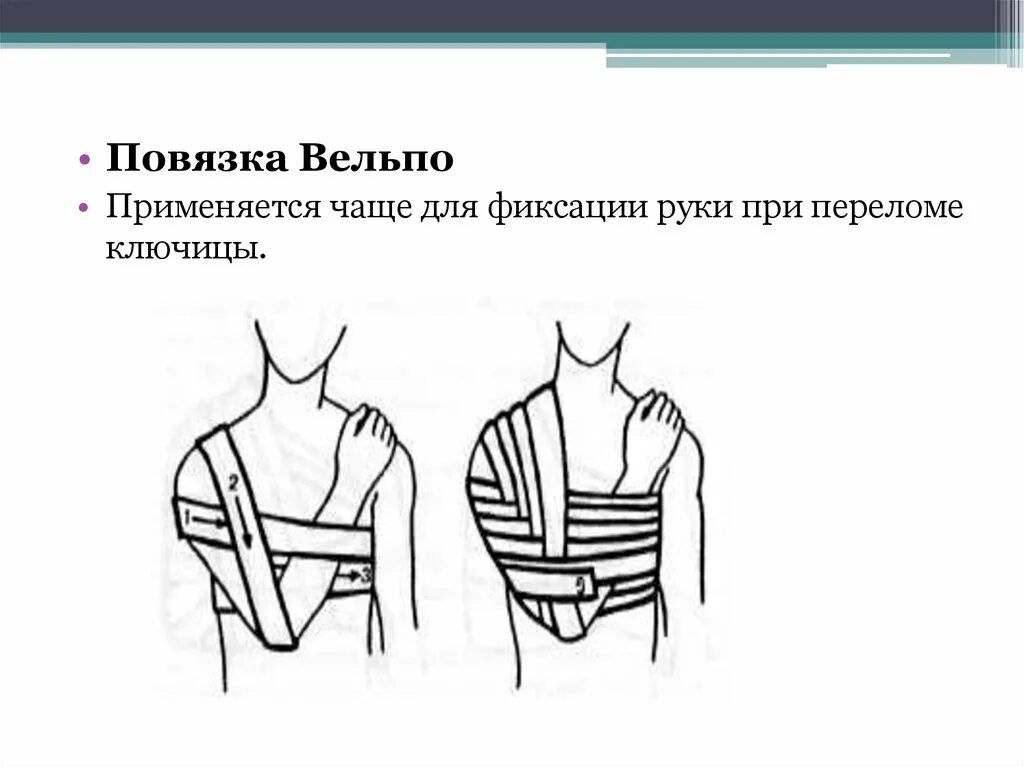 Показания к наложению повязки Вельпо. Вельмо повязка техника. Повязки Дезо и Вельпо алгоритм. Повязка Дезо и Вельпо.