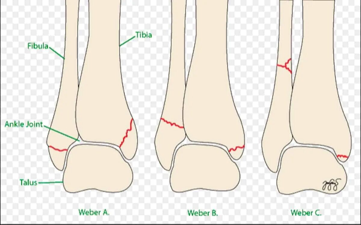 Наружная лодыжка анатомия. Перелом лодыжки анатомия. Наружная лодыжка и малоберцовая кость. Лодыжка и берцовая кость.