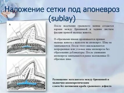 Герниопластика это
