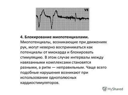Экг сегмент st на изолинии