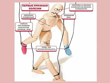 Склероз конечностей симптомы
