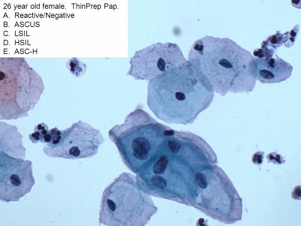 ASCUS цитология расшифровка. ASCUS цитология шейки матки. Плоский эпителий в цитограмме