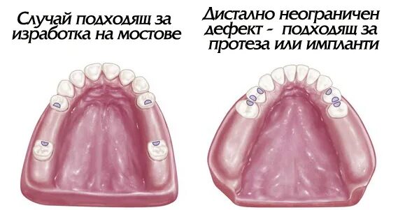 Концевые дефекты зубных рядов. Концевые дефекты зубных рядов