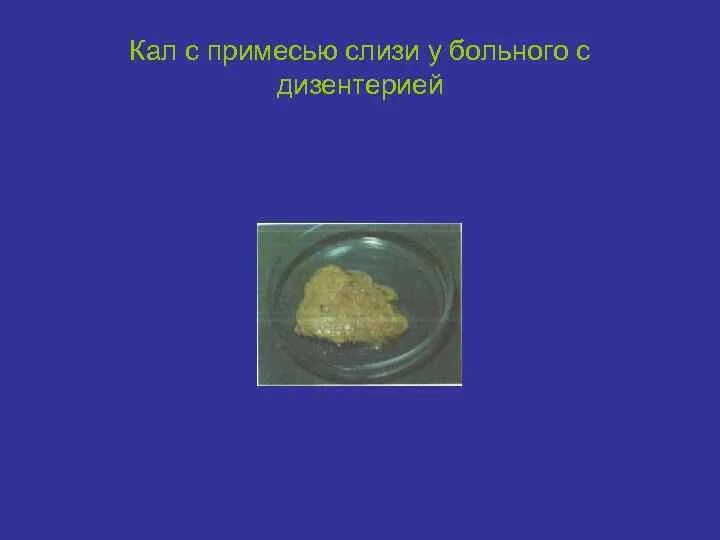 Примеси в мокроте. Характер стула при дизентерии. Кал при бактериальной дизентерии. Кал при дизентерии у детей. Характер стула при острой дизентерии:.