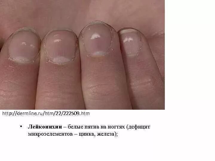 Заболевание ногтей лейконихия. Поперечные полосы на ногтях. Пятна на ногтях витамины. Пятна на ногтях витамины. Пятна на ногтях витамины.