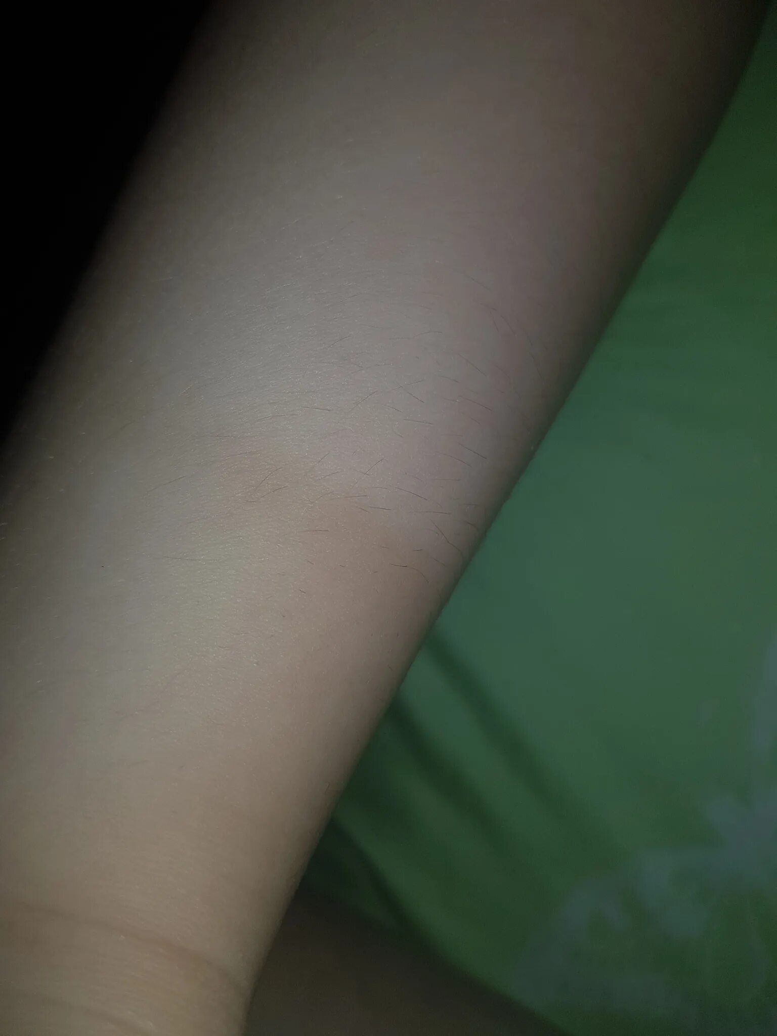 Отпечаток на коже от резинки. Остаются следы от резинки. Остаются следы от резинки. Отпечаток на коже от резинки. Остаются следы от резинки.