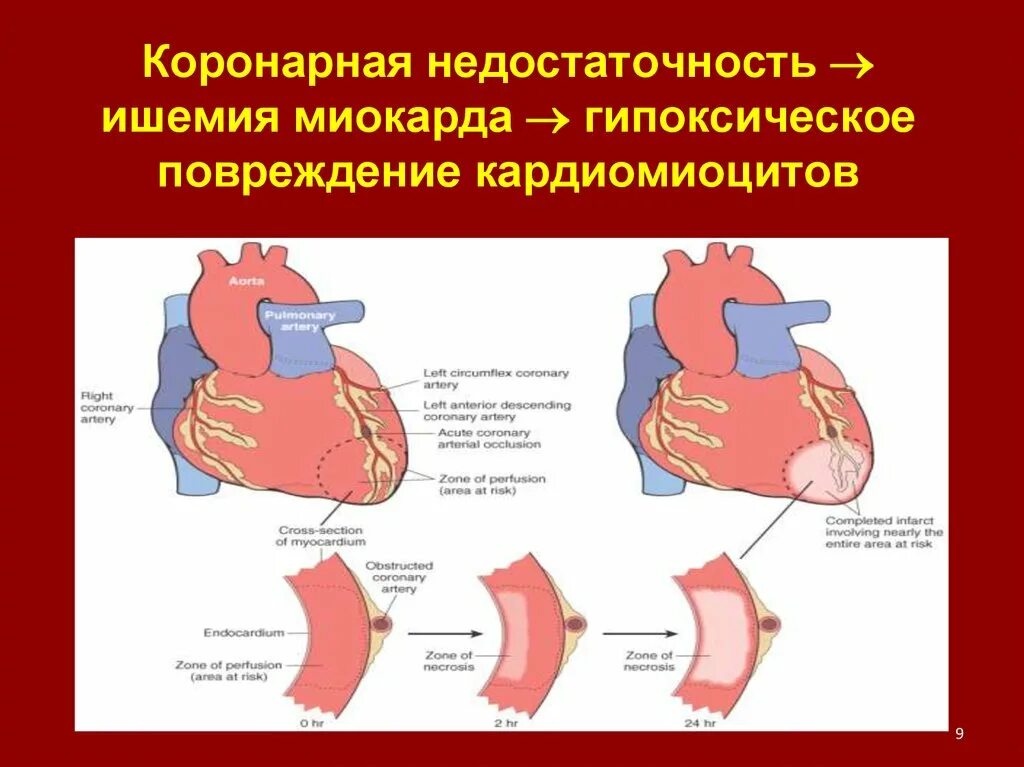 Коронарная ишемия. Синдром острой коронарной недостаточности симптомы. Коронарогенная коронарная недостаточность. Проявление синдрома коронарной недостаточности. Синдром ишемического повреждения миокарда.