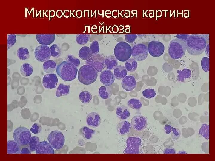 Недифференцированный лейкоз. Острый лейкоз картина крови.