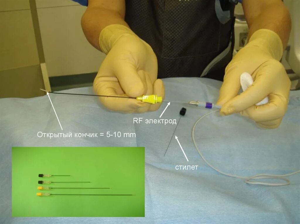 Где делают абляцию. Радиочастотная катетерная абляция сердца.