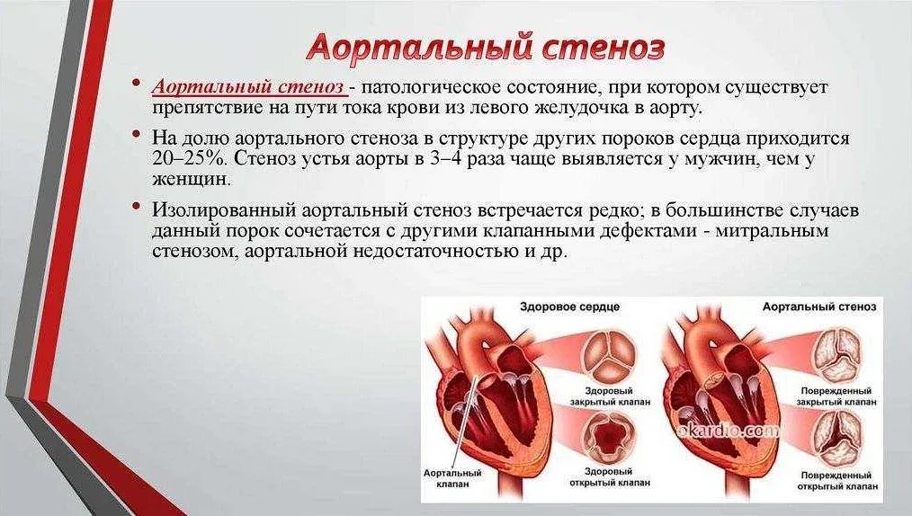 Можно вылечить стеноз. Порок сердца стеноз аортального клапана. митральные пороки сердца (стеноз, недостаточность. атеросклеротический порок аортального клапана. атеросклеротический стеноз аортального клапана.