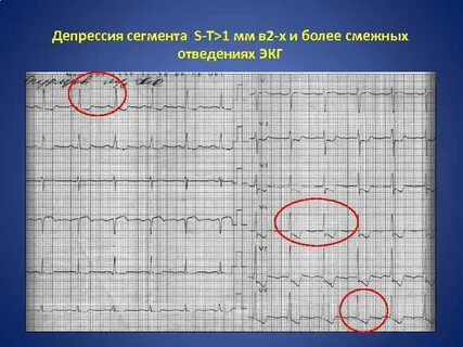 Депрессия сегмента st 2 мм