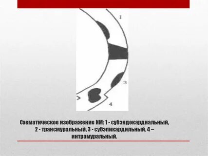 Интрамуральная гематома аорты