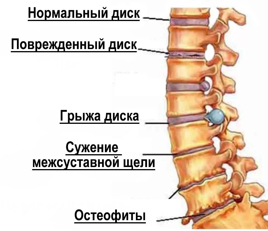 Остеохондроз позвоночника у взрослых шейного отдела. Остеохондроз th5-th8. Остеохондроз грудного отдела позвоночника симптомы. Остеохондроз грудного и поясничного отдела. Стадии развития остеохондроза.