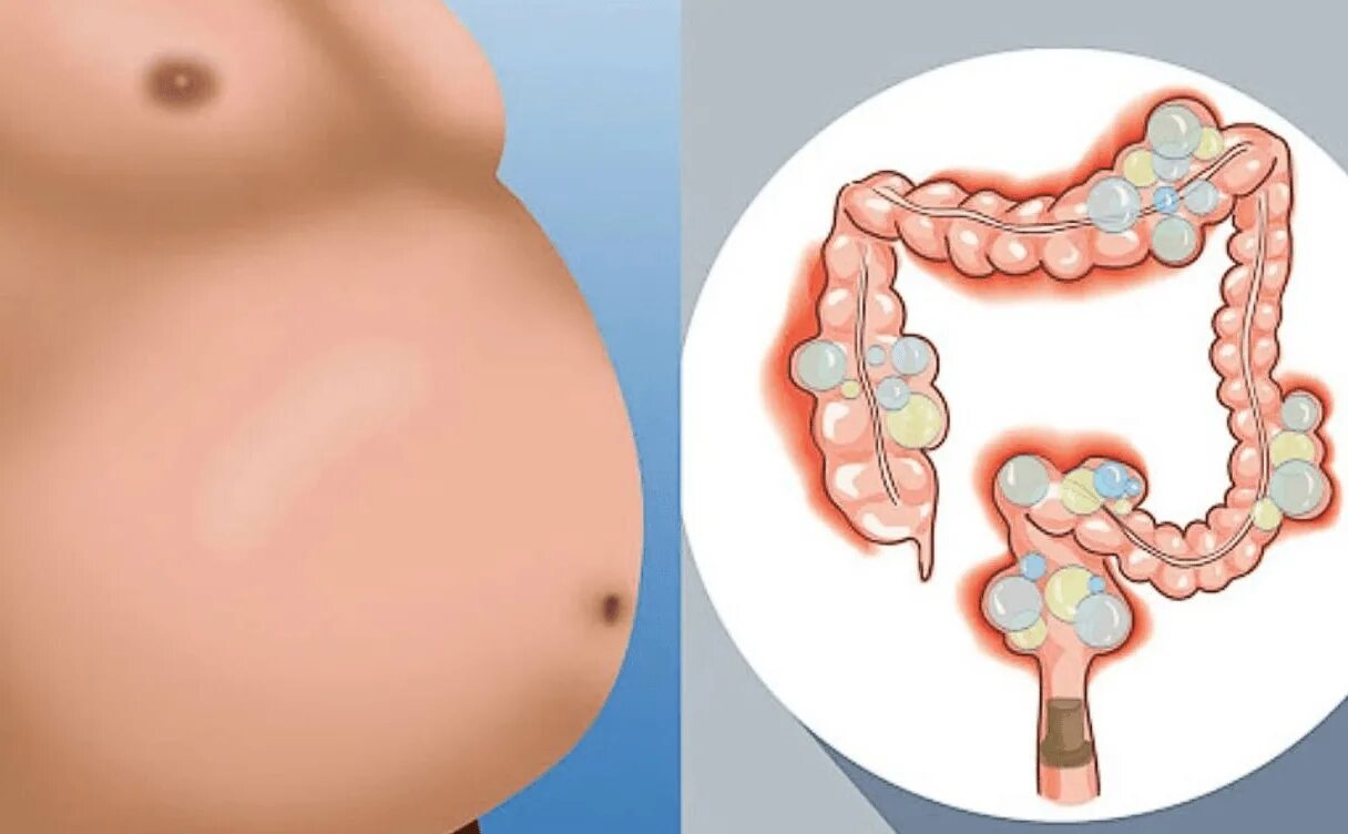 Кишечник и вздутие живота.
