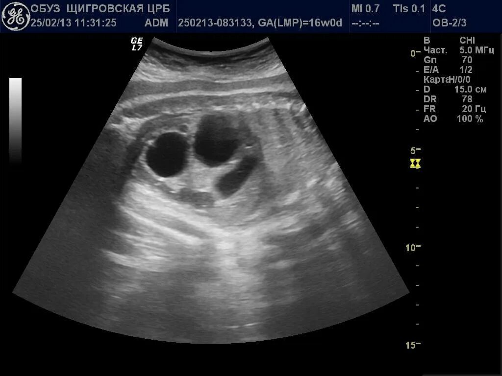 Лоханки при беременности. Мультикистоз почек на УЗИ. Мультикистоз почки у плода. Гидрокаликоз на УЗИ. Мультикистоз почек плода УЗИ.