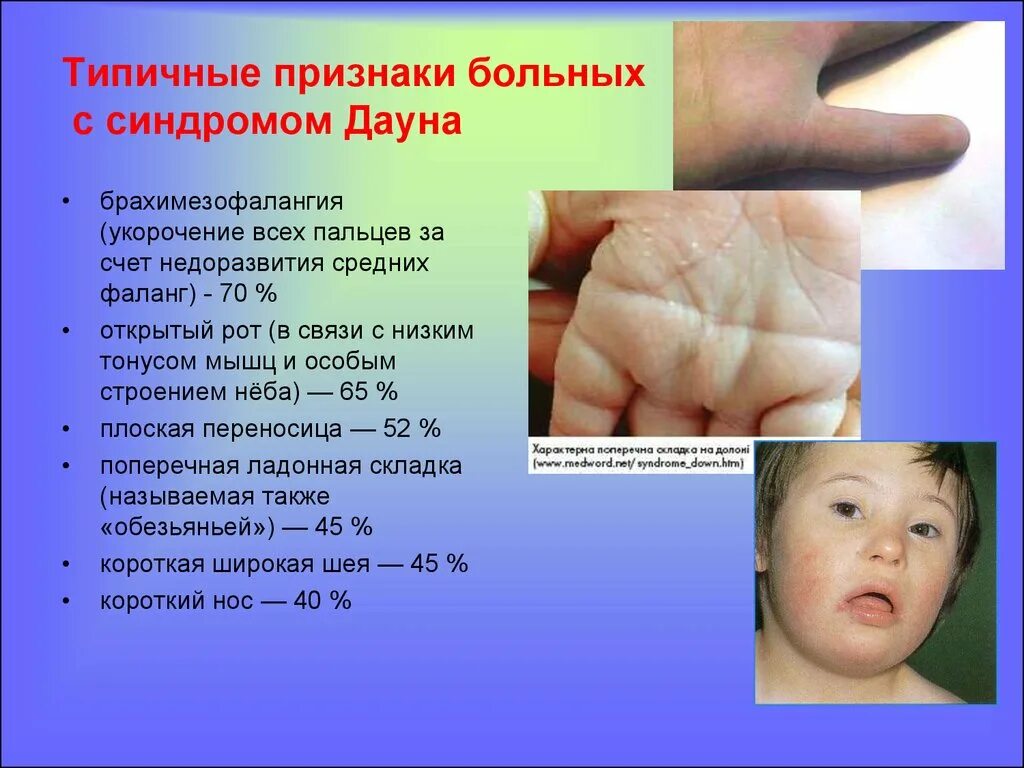 Как определить синдром. Синдром дауна проявления. силромы дауны симптомы. признаем синдрома дауна.