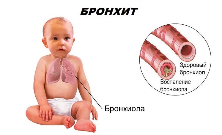 Бронхиты у детей клинические