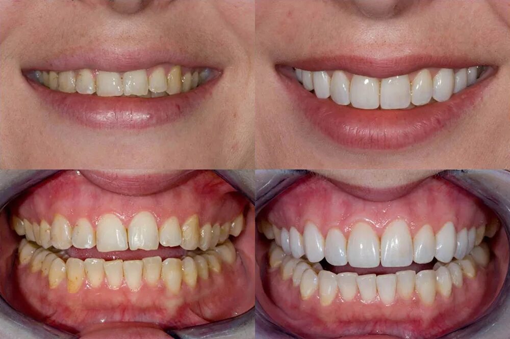 Восстановление передних зубов. Изменение формы зубов