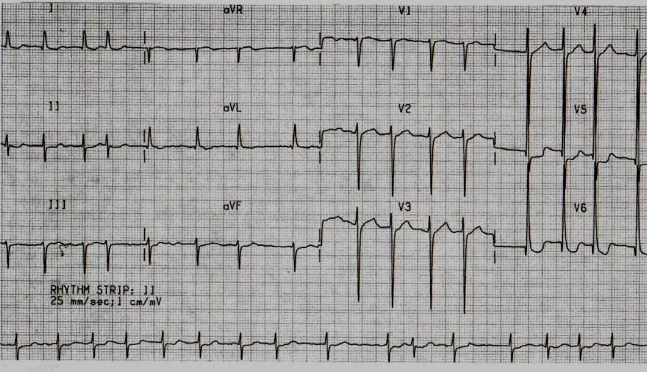 Гипертрофия левого желудочка на ЭКГ. Гипертрофия лж на ЭКГ. ЭКГ гипертрофия левого желудочка ЭКГ. ЭКГ при гипертрофии левого желудочка при артериальной гипертензии. Тяжелое экг