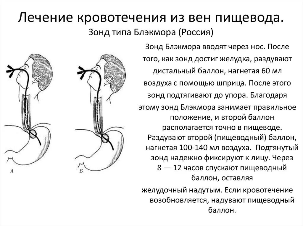 Остановка кровотечения из варикозно расширенных вен. Зонда-обтуратора Сенгстакена-Блэкмора. Методика постановки зонда Сенгстакена-Блэкмора. Баллонная тампонада зонд Блэкмора. Установка зонда Блэкмора техника.