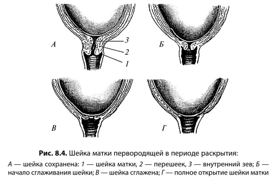 Маточный зев. Внутренний зев матки при беременности. Схема раскрытия шейки матки. Раскрытие внутреннего зева шейки матки. Степень раскрытия маточного зева.