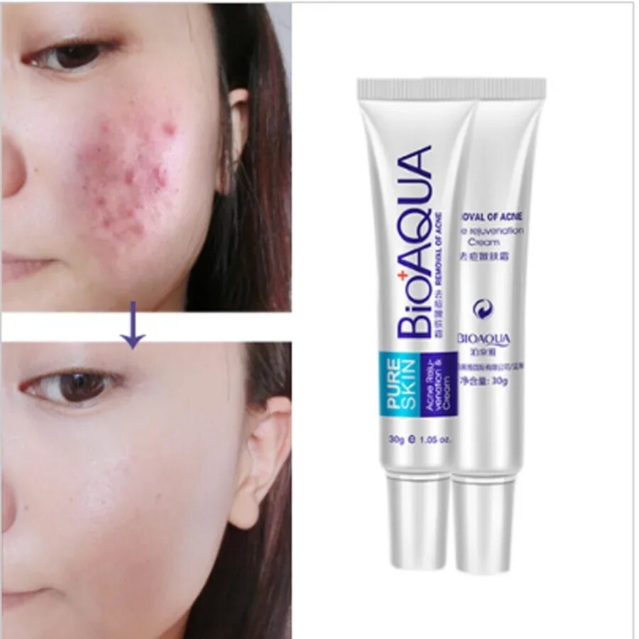 Крем BIOAQUA против против акне. Крем анти-акне BIOAQUA. Анти-акне крем Anti-acne Cream. Крем анти акне БИОАКВА китайский.