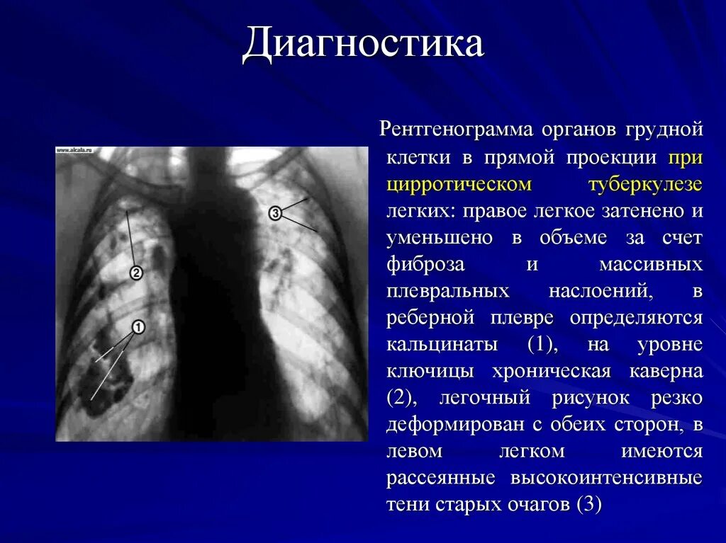 Туберкулез молочной. Цирротический туберкулез легких диагностика. Цирроз легкого туберкулез рентген. Цирротический туберкулез рентген описание. Рентгенограмма грудной клетки при туберкулезе.