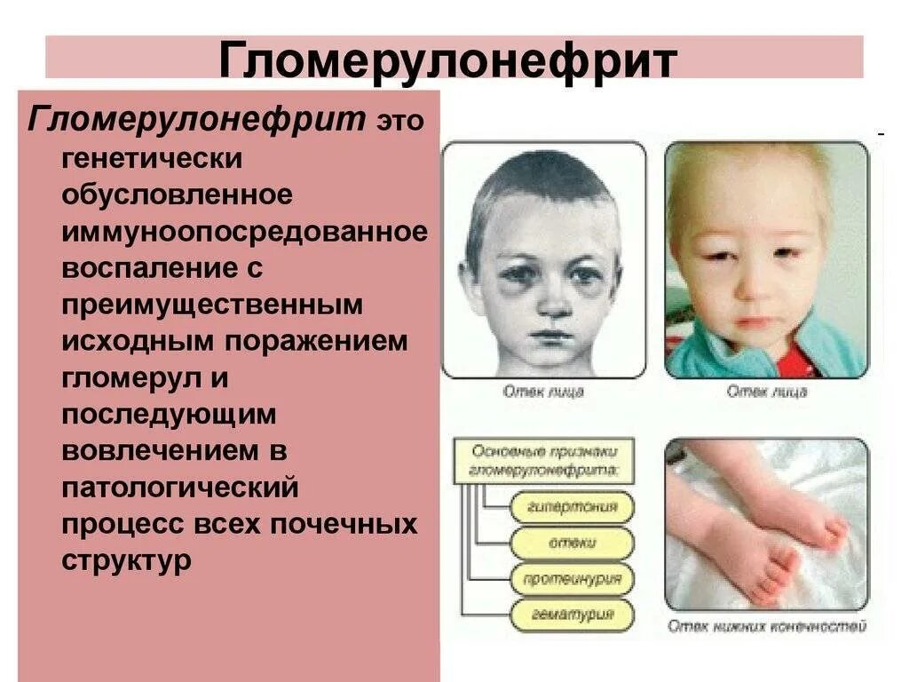 Проблемы гломерулонефрита
