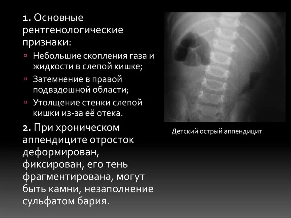 Основные рентгенологические симптомы. Утолщение стенок кишечника. Утолшениестеноккишечника. Утолщение стенок прямой кишки. Правая подвздошная кишка