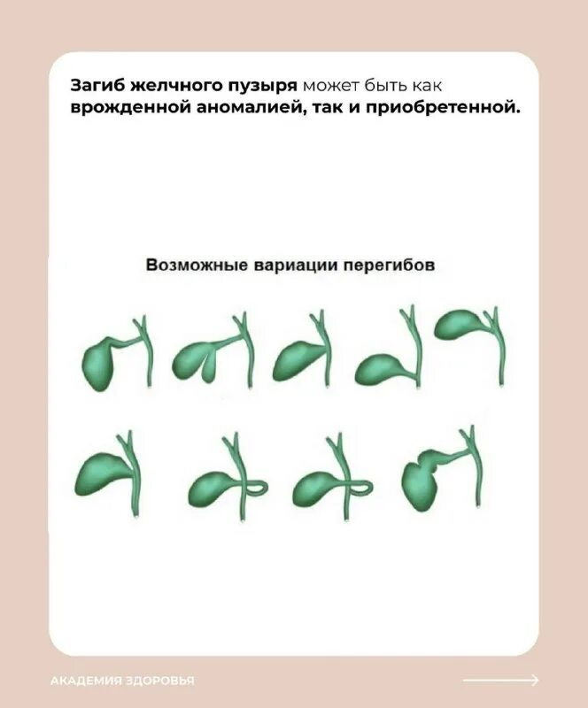 Загиб желчного протока. Загиб желчного протока