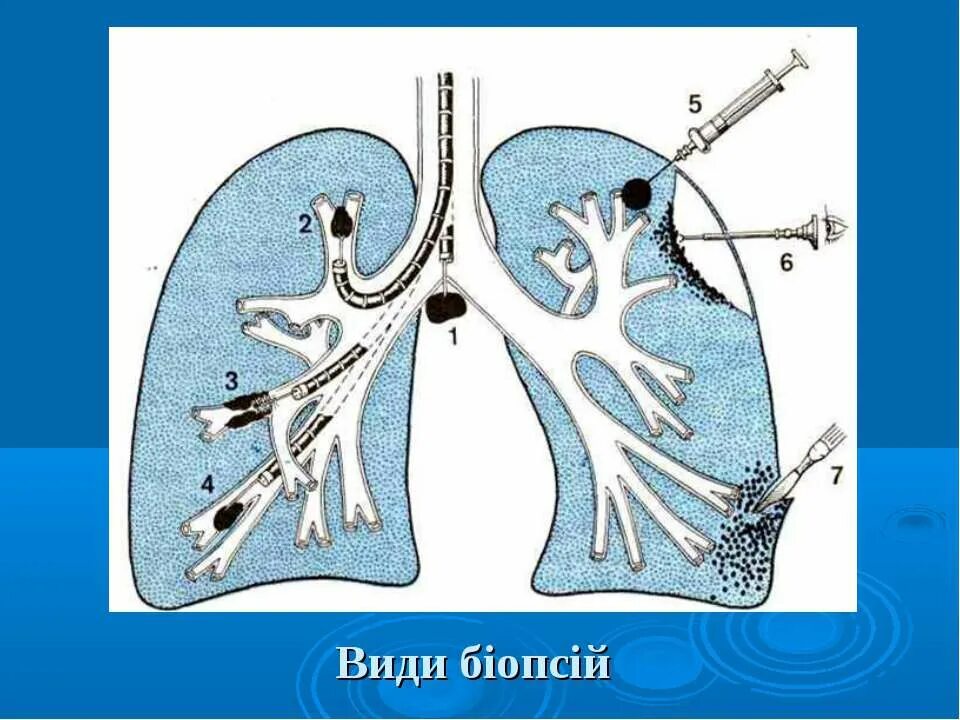 Как делают биопсию легких. Патогенез туберкулемы легких. Патогенез туберкулемы легкого.