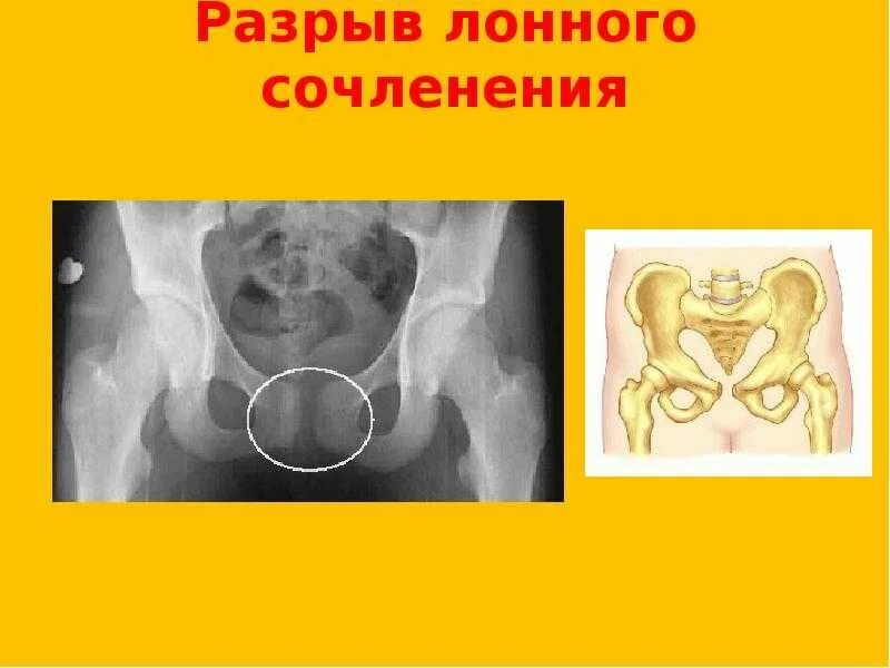 Что такое симфизит у беременных. Симфизит 2 степени. симфизит лонного сочленения у беременных.