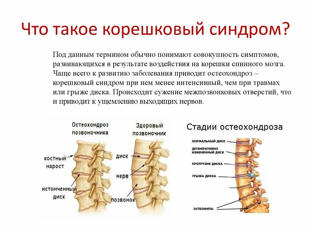 Поражение корешковых нервов. Корешок l3 корешковый синдром. Вертеброгенный корешковый синдром. Корешок l2-3. Корешковый синдром с7.