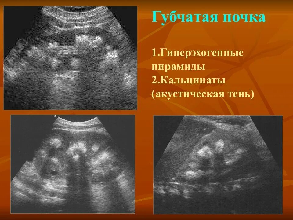 Акустические тени в почках. Синдром гиперэхогенных пирамид на УЗИ. Синдром белых пирамидок в почках на УЗИ. Синдром гиперэхогенных пирамид почек УЗИ. Медуллярная губчатая почка УЗИ.