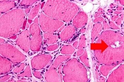 Myositis латынь
