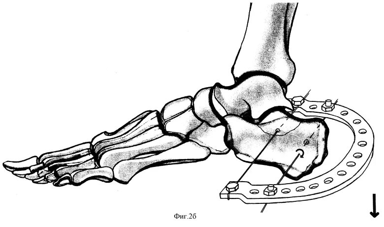 Операция пяточной кости. Скелетное вытяжение пяточной кости. Перелом пяточной кости остеосинтез. Перелом пяточной кости репозиция. Гипсовая иммобилизация при переломе пяточной кости.