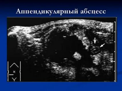 Аппендикулярный инфильтрат абсцесс