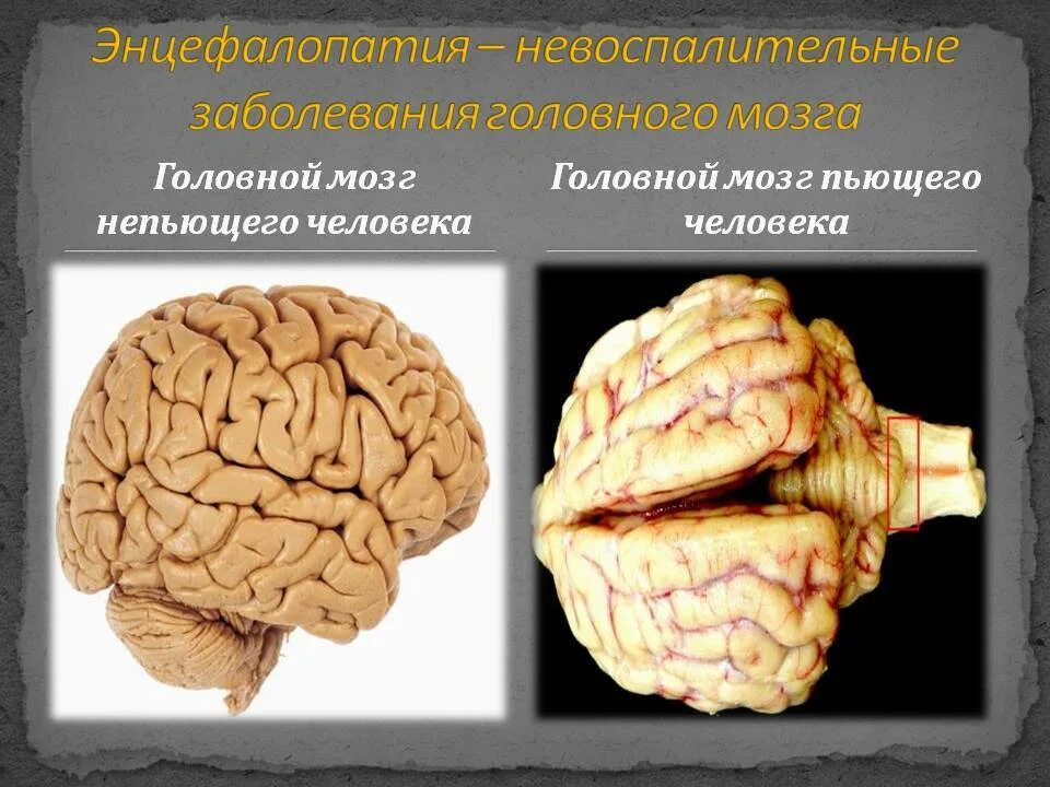 Патология головного мозга. Алкогольная энцефалопатия. Поражение головного мозга.