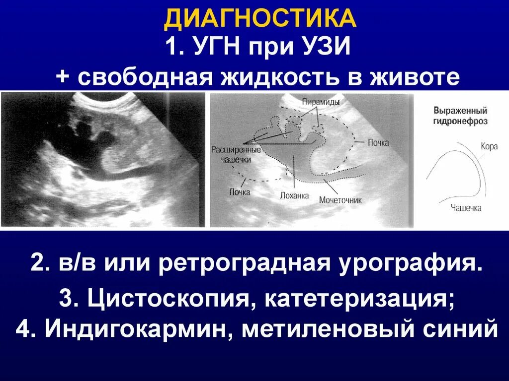 Травма мочеточника. Расширенный мочеточник на УЗИ. Свободная жидкость на УЗИ. Травма мочеточника УЗИ.