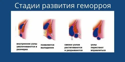 Внешний геморрой отзывы женщин