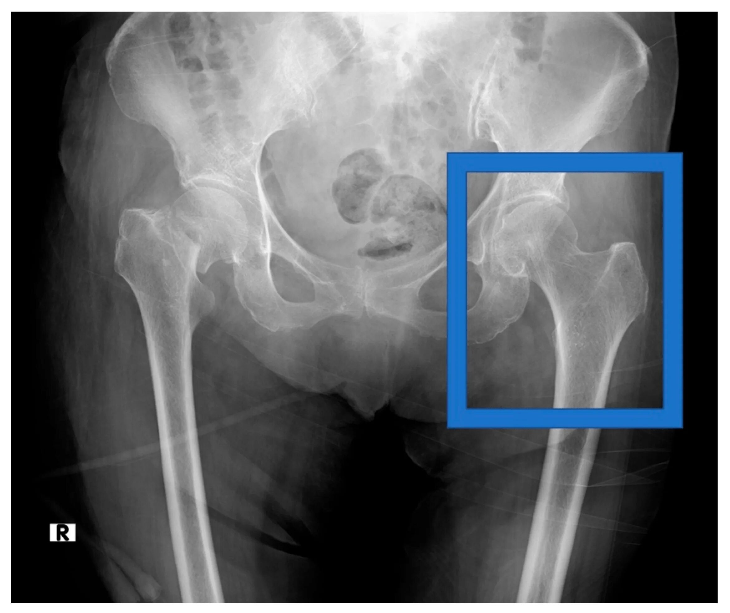 Остеоартрит тазобедренного сустава рентген. Osteoporosis XRAY. Артроз тазобедренного сустава рентген. Артроз тазобедренного сустава на снимке. Xray extension