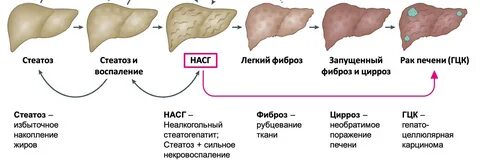 Эхопризнаки гепатоза
