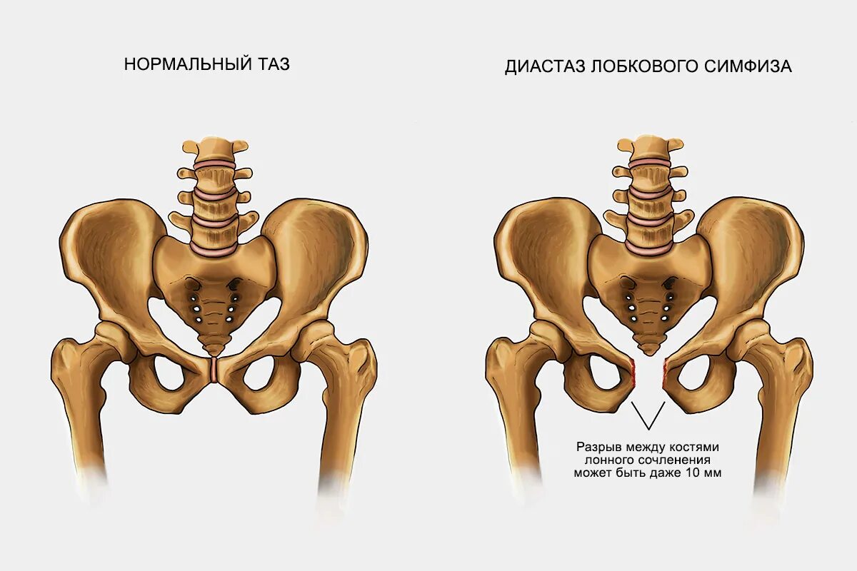 расхождение костей таза при беременности. узи костей лонного сочленения при беременности. расхождение костей при беременности симптомы. симфизит при беременности. расхождение костей при беременности симптомы.