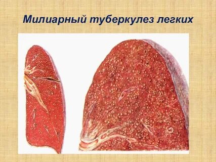 Туберкулез легких макропрепарат