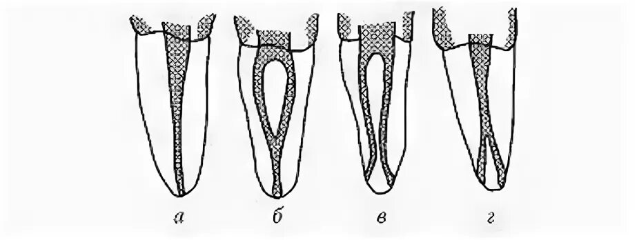 Анатомия корневого канала зуба. Типы корневых каналов зубов. Классификация корневых каналов Vertucci. Типы строения корневых каналов по Wein. Формы корневых каналов