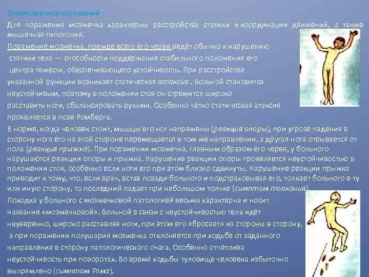 Нарушение координации движения руки
