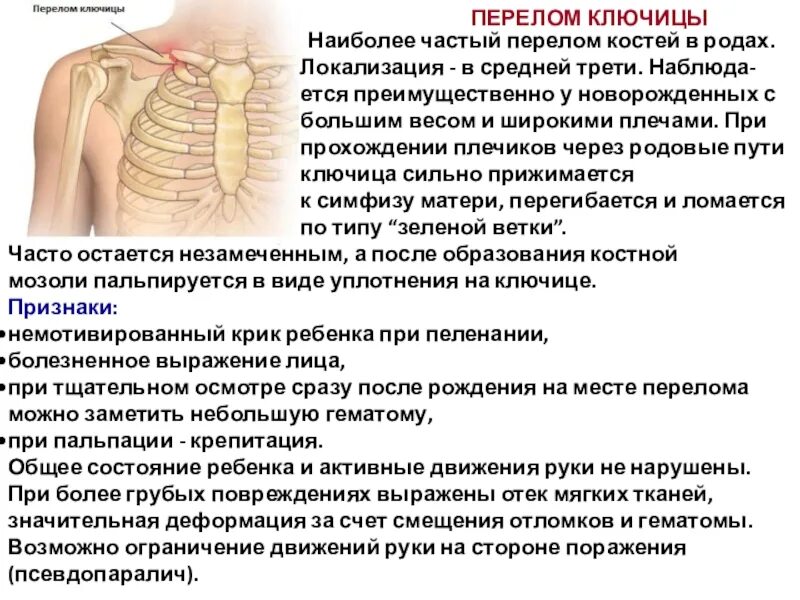 Лечение перелома ключицы у детей. Перелом ключицы повязка дезо кольца дельбе. Оскольчатый перелом ключицы. Перелом ключицы у новорожденного. Внесуставной перелом ключицы.